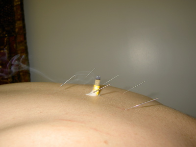 Acupuncture Treatment