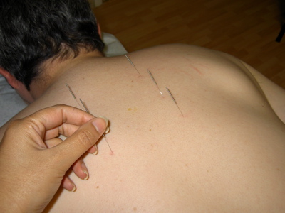 Acupuncture Treatment